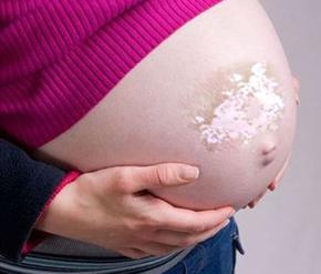 白癜风孕妇在治疗期间饮食需要注意什么